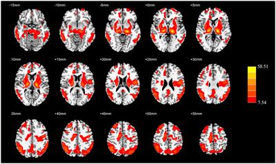 The convergent and divergent patterns in brain perfusion between Alzheimer's disease and Parkinson's disease with dementia: An ASL MRI study